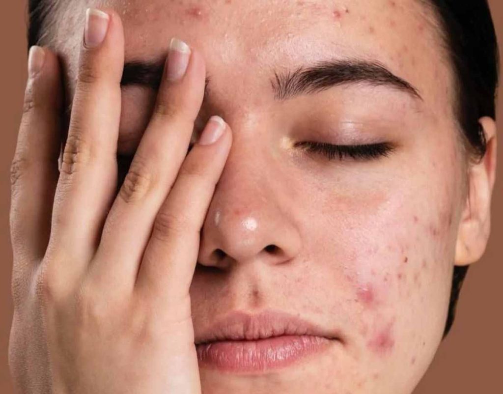 Clear Your Skin 2