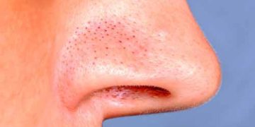 How to Get Rid of Blackheads on Your Nose: A Step-by-Step Guide for 2026