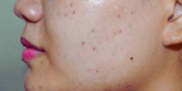 How to Get Rid of Dark Spots Fast: A Step-by-Step Guide for 2026