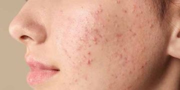How to Get Rid of Pimples Overnight: A Step-by-Step Guide for 2026