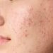 How to Get Rid of Pimples Overnight: A Step-by-Step Guide for 2026